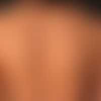 Kindler Syndrom:&nbsp;seit Geburt Blasenbildung; jetzt poikilodermatisches Erscheinungsbild.&nbsp;
