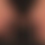 Yellow-nail-Syndrom:&nbsp;gelblich verfärbte und gleichmäßig verdickte Nägel (Skleronychie).&nbsp;
