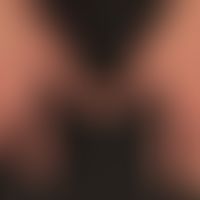Yellow-nail-Syndrom:&nbsp;gelblich verfärbte und gleichmäßig verdickte Nägel (Skleronychie).&nbsp;
