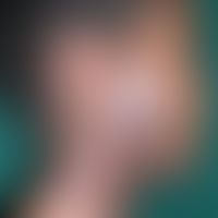Zoster:&nbsp;Schwerer, nicht ganz frischer&nbsp;nekrotsierender Zoster mit tiefer Narbenbildung. ...