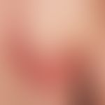 Zoster: akuter segmentaler Zoster. Multiple über das Segment hinausgehende Paplen und Paplu- Vesi...