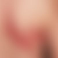 Zoster: akuter segmentaler Zoster. Multiple über das Segment hinausgehende Paplen und Paplu- Vesi...