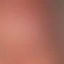 Zoster ophthalmicus:&nbsp;seit 6&nbsp;Tagen zunehmende, linksseitige&nbsp;Kopfschmerzen mit begle...
