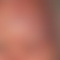 Zoster ophthalmicus: seit 6&nbsp;Tagen zunehmende, linksseitige&nbsp;Kopfschmerzen mit begleitend...