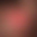 Zylindrom: fest-elastischer, haarloser, roter Knoten mit spiegelnder Oberfläche, von Teleangiekta...
