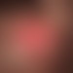 Cylindrome: firmly elastic, hairless, red knot with a reflecting surface, interspersed with telan...