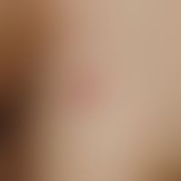 Varicella in dark skin: detailed picture.
