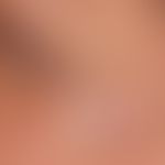 Vaskuläre Malformation (venöse vaskuläre Malformation): Der Pfeil kennzeichnet den kutanen Anteil...