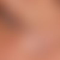 Vaskuläre Malformation (venöse vaskuläre Malformation): Der Pfeil kennzeichnet den kutanen Anteil...