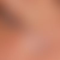 Vaskuläre Malformation (venöse vaskuläre Malformation):&nbsp;seit Jahren unveränderte, weiche, un...