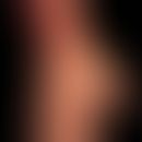 Verätzung:&nbsp;nicht ganz frische oberflächliche Laugenverätzung.
