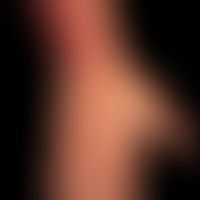 Verätzung:&nbsp;nicht ganz frische oberflächliche Laugenverätzung.
