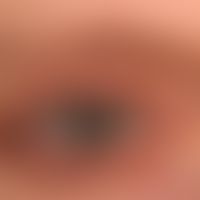 Apocrine cysts of the sweat glands on the edge of the upper eyelidand in the medial corner of the...