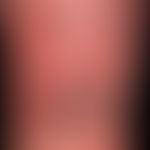 Vaskulitis, leukozytoklastische (non-IgA-assoziierte):&nbsp;große, hämorrhagische Blasen auf fläc...