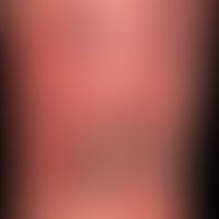 Vaskulitis, leukozytoklastische (non-IgA-assoziierte):&nbsp;große, hämorrhagische Blasen auf fläc...