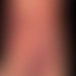 Vaskulitis, leukozytoklastische (non-IgA-assoziierte):&nbsp;multiple, petechiale Einblutungen und...