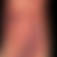 Vaskulitis, leukozytoklastische (non-IgA-assoziierte):&nbsp;multiple, petechiale Einblutungen und...
