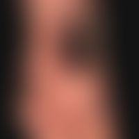 Vaskulitis, leukozytoklastische (non-IgA-assoziierte):&nbsp;flächenhafte Nekrosen am Fußrücken na...