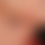 Lymphangioma cavernosum.&nbsp;Sog. Hämato-Lymphangiom. Kutan-subkutan lokalisierte, zackig begren...