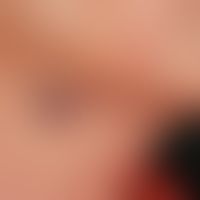 Lymphangioma cavernosum.&nbsp;Sog. Hämato-Lymphangiom. Kutan-subkutan lokalisierte, zackig begren...