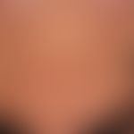 Urticaria pigmentosa: variously large, disseminated, flat, oval or round, brownish-red spots on t...