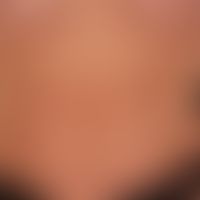 Urticaria pigmentosa: variously large, disseminated, flat, oval or round, brownish-red spots on t...