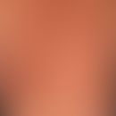 Urticaria pigmentosa "exanthematische" Form:&nbsp;Übersichtsaufnahme: seit > 10 Jahren bestehe...