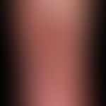 Ulcus cruris arteriosum:arterial leg ulcer that has been presentforabout 1 year, continuously exp...