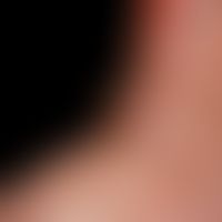 Arterielle Verschlusskrankheit periphere: seit etwa 1 Jahr bestehendes, sich&nbsp;kontinuierlich ...