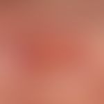 Ulcus cruris arteriosusum: chronic arterial (sharp-edged) ulcer with known occlusive arterial dis...