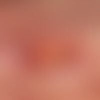 Ulcus cruris arteriosusum: chronisches arterielles (scharfberandetes) Ulkus bei bekannter &nbsp;a...
