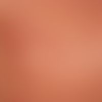Urticarial vasculitis. 33-year-old female patient with distinct reduction of the az. 3 weeks of r...