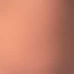 urticaria chronic spontaneous: multiple,chronically recurrent, reddish, partly confluent wheals, ...