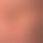Urticaria, chronic spontaneous:multiple, chronically recurrent, reddish, partly confluent wheals,...