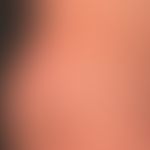 Urticaria, chronic spontaneous:multiple, chronically recurrent, reddish, partly confluent wheals,...