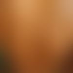 Urticaria in dark skin, due to the omission of the "red tones", compared to light skin, completel...
