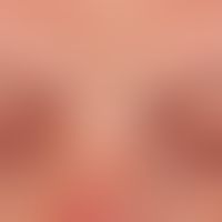 Ulerythema ophroygenes&nbsp;(hier atrophisches Endstadium nach jahrzehntelangem Verlauf; Krankhei...
