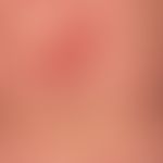 Toxic epidermal necrolysis: early stage of toxic epidermal necrolysis with incipient extensive ep...