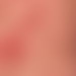 Toxic epidermal necrolysis: early stage of toxic epidermal necrolysis with incipient planar epide...