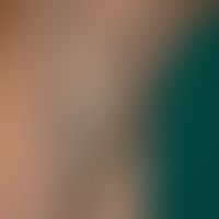 Trichobacteriosis axillaris: schwer abstreifbare, die Haare umhüllende Beläge von gelber Farbe. M...