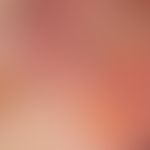 Toxic epidermal necrolysis: highly acute stage of toxic epidermal necrolysis with the formation o...