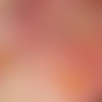 Toxische epidermale Nekrolyse.: hochakutes Stadium einer toxischen epidermale Nekrolyse mit Ausbi...