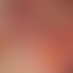 Toxic epidermal necrolysis: highly acute stage of toxic epidermal necrolysis with the formation o...