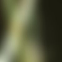 Bambus-Haar: charakteristische Haarschaftanomalie &nbsp;mit kugelgelenkartiger&nbsp;Invagination ...