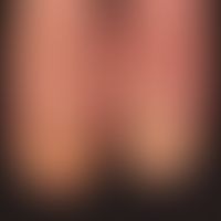 Spotted nails: unusually pronounced, dimpled nail dystrophies in known psoriasis; keratotic chang...