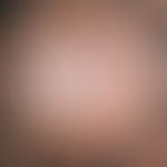 Tinea capitis superficialis:a slowly centrifugally growing, marginally dead centre that has been ...