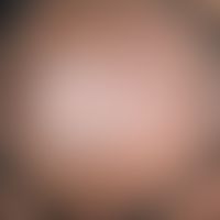 Tinea capitis superficialis:a slowly centrifugally growing, marginally dead centre that has been ...