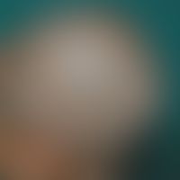 Tinea capitis (microspores): diffuse infestation of the entire capillitium. only moderate itching...