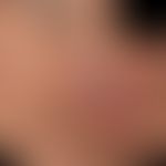 Tinea faciei.&nbsp;Seit mehreren Monaten bestehende schmerzende Plaques und Knoten.
