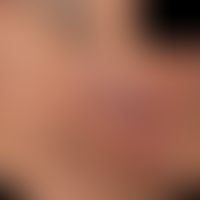 Tinea faciei.&nbsp;Seit mehreren Monaten bestehende schmerzende Plaques und Knoten.
